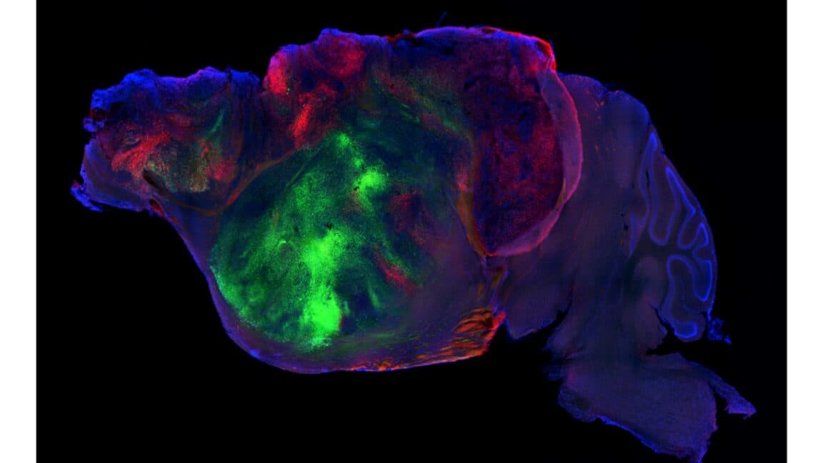 Diagram showing human cortical tissue integration into a mouse brain, highlighting research on neurodevelopmental disorders.