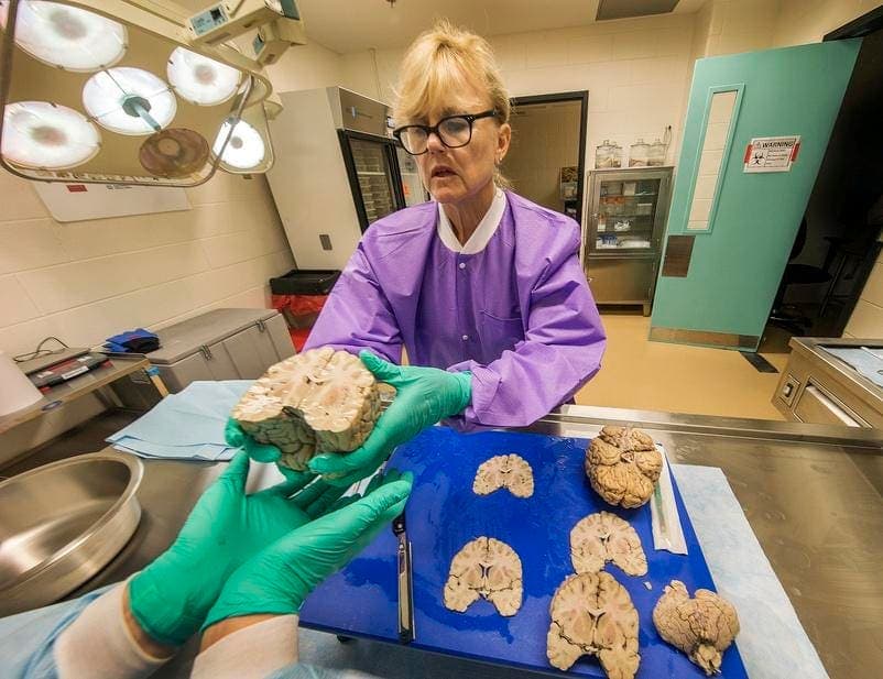 Study Reveals 25% CTE Prevalence Among Former NFL Players Who Died 2016-2021