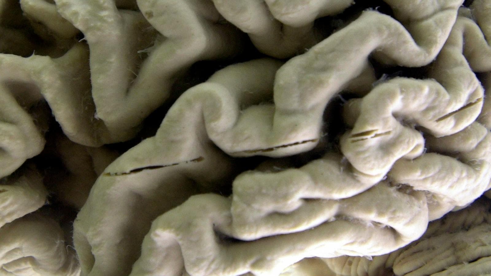 Blood test for predicting Alzheimer's risk in older adults