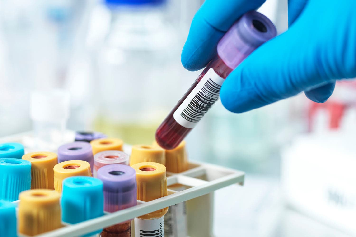 ACC and AHA release 2026 dyslipidemia guidelines recommending screening from age 30