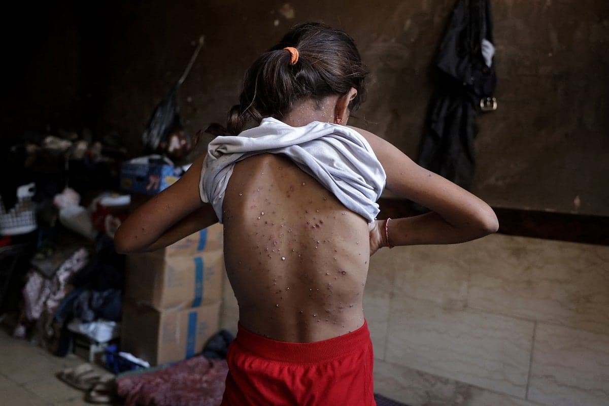 Children in Gaza displacement camps affected by chickenpox outbreak